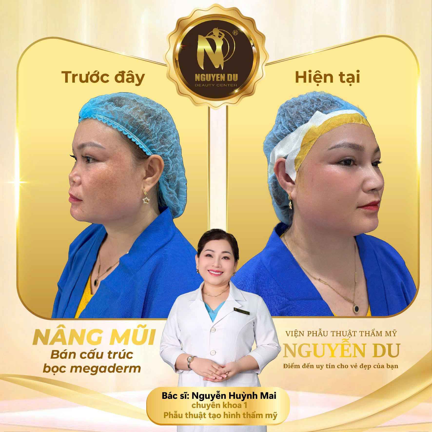 nâng mũi bán cấu trúc